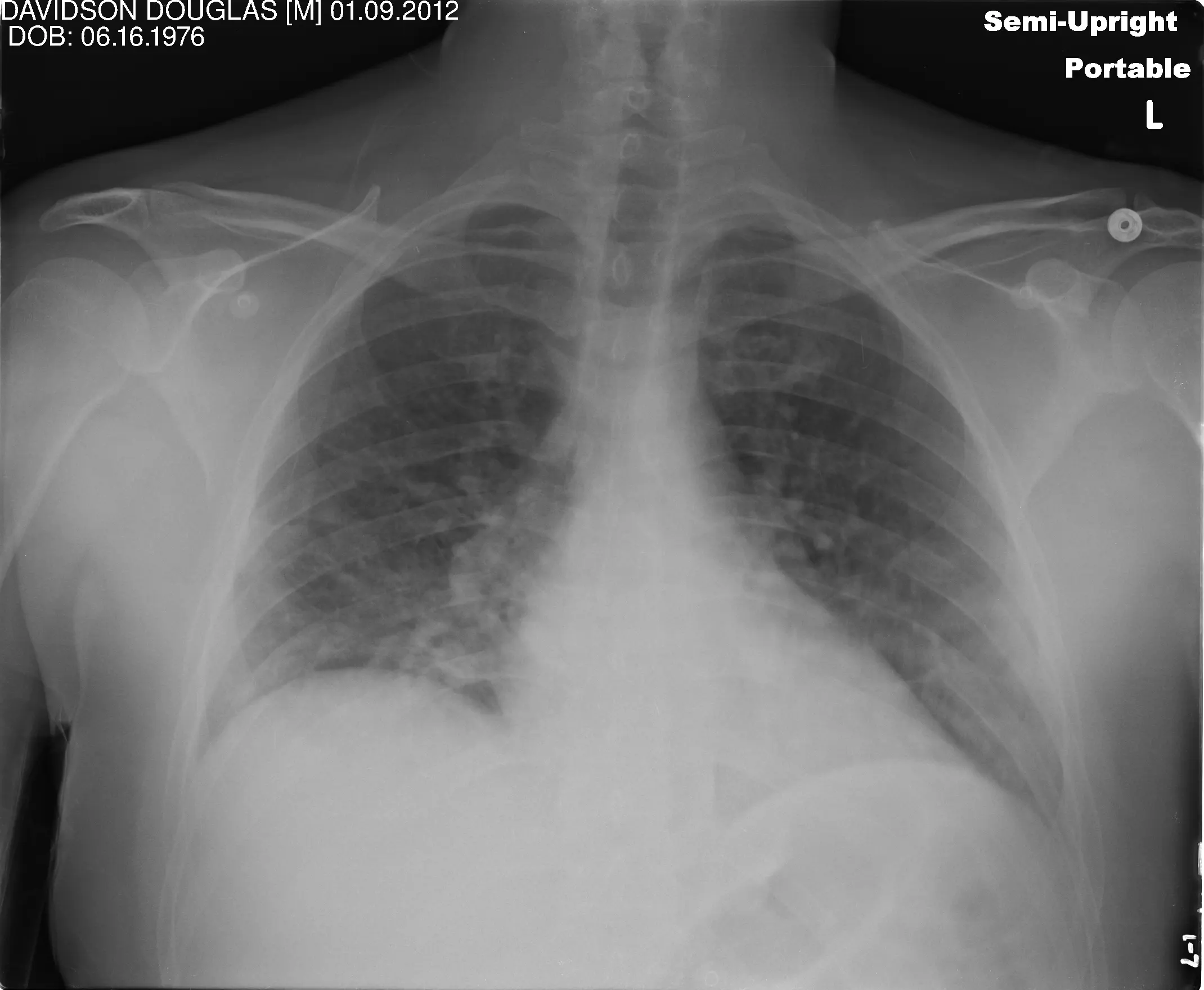 lung before